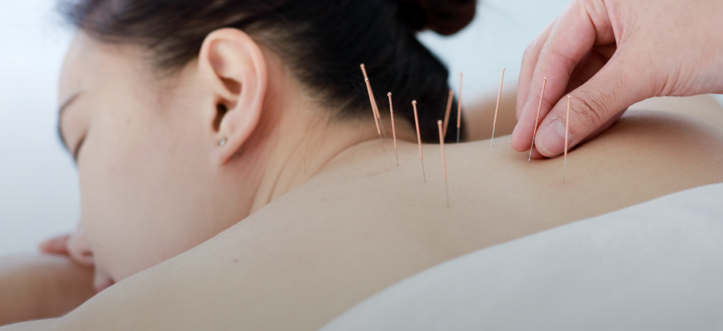 How to Find the Best Acupuncture Near Me for Lasting Relief and Wellness
