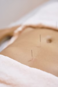 acupuncture services Winchester