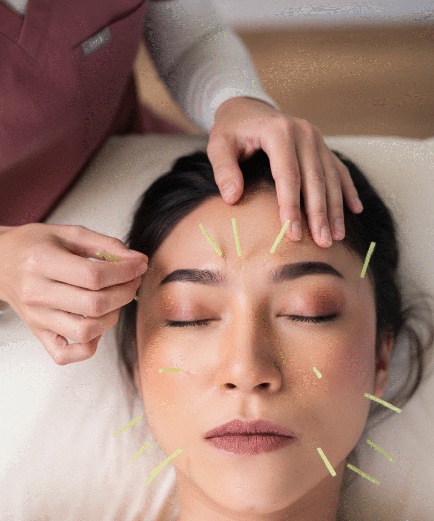 facial acupuncture in Winchester